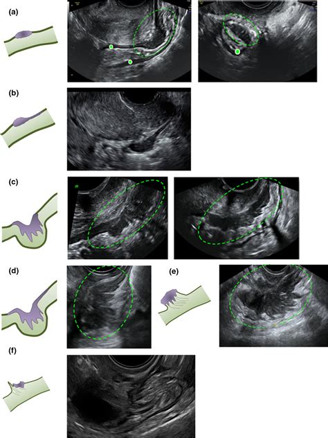 ultrasound diagnosis of endometriosis